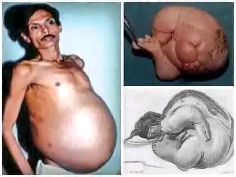 Historia de un hombre que vivió con un feto