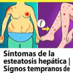 La Esteatosis Hepática: Síntomas y Signos Tempranos que Debes Conocer