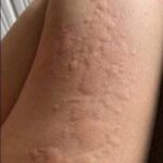 Picaduras en la Piel: Identificación y Tratamientos Naturales
