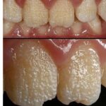 Cuidado Dental: Cómo Proteger el Esmalte y Mantener una Sonrisa Saludable