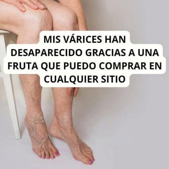 Várices
