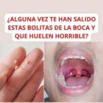 Todo lo que necesitas saber sobre los cáseos amigdalinos: causas, síntomas y remedios naturales