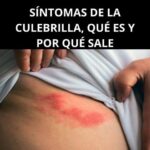 Síntomas de la Culebrilla: Qué Es y Por Qué Surge