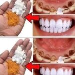 Blanqueamiento Dental Natural: Mejora Tu Sonrisa con Bicarbonato y Cúrcuma