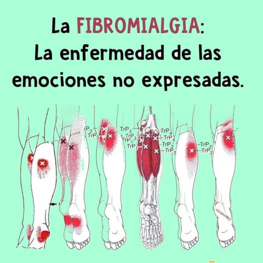 Puntos de dolor de la fibromialgia