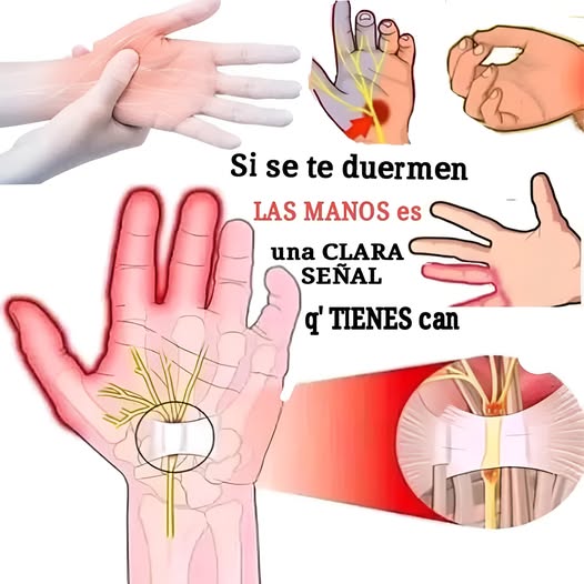 Diagrama sobre el síndrome del túnel carpiano