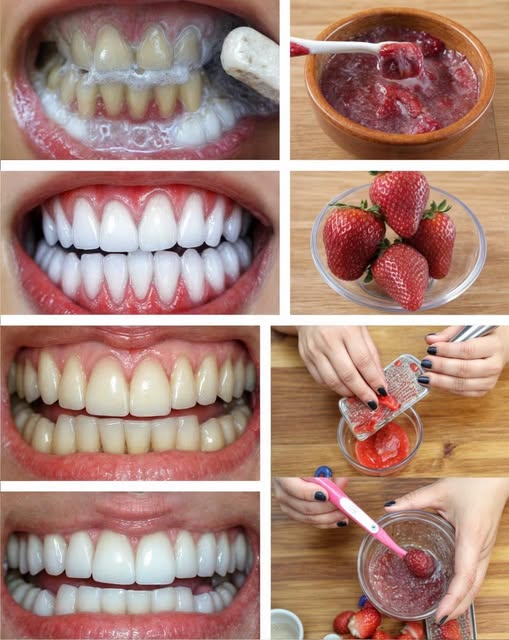 Proceso de blanqueamiento dental con fresas