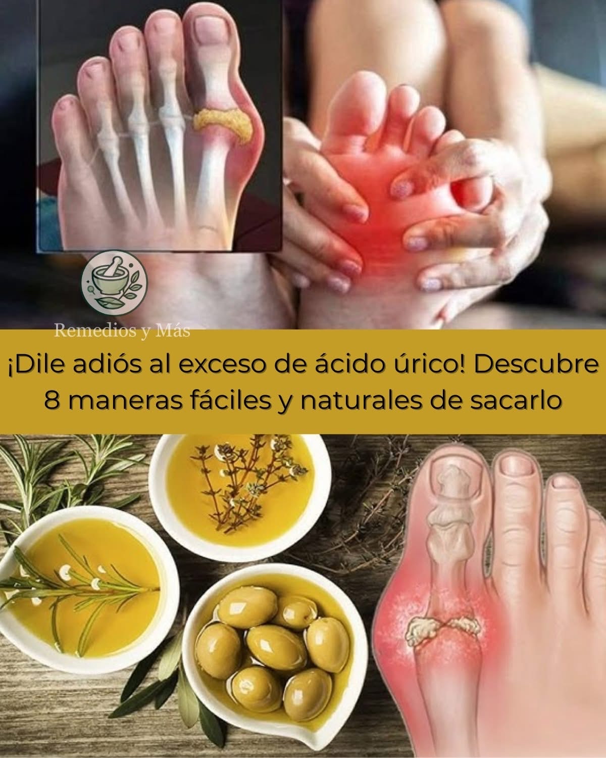Representación gráfica de un pie afectado por altos niveles de ácido úrico