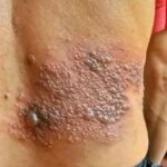 Cómo Identificar y Tratar Erupciones Cutáneas: Remedios Naturales y Consejos de Salud
