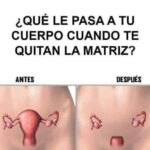 Impacto en Tu Cuerpo Tras la Histerectomía: Lo Que Necesitas Saber