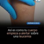 Cómo Reconocer los Síntomas de Alerta de la Leucemia