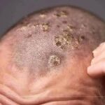Cuídalo: Remedios Naturales para Afecciones del Cuero Cabelludo