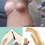 Gangliones en la Muñeca: Síntomas, Causas y Remedios Naturales