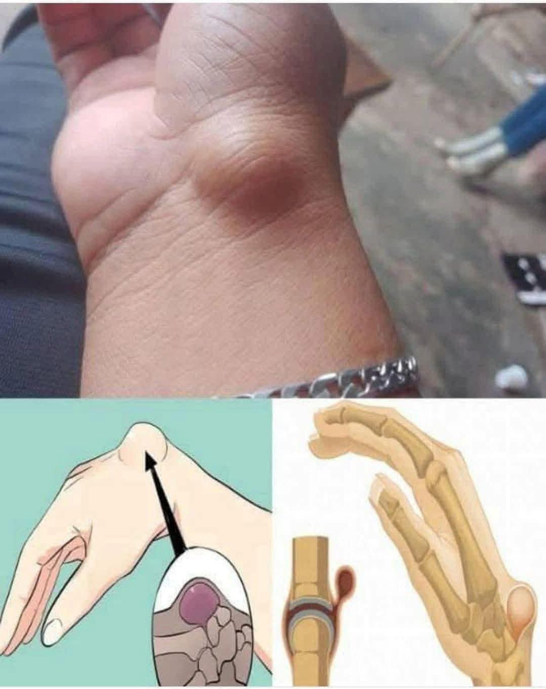 Imagen de un ganglión en la muñeca