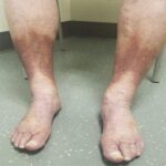 Señales en tus Pies que Indican Riesgo de Diabetes: Prevención y Remedios Naturales