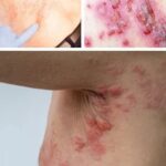 Cómo Combatir las Erupciones Cutáneas Causadas por el Estrés: Remedios Naturales y Consejos de Salud