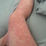 Signos de Problemas en la Piel: Identificación y Remedios Naturales
