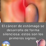 Cáncer de Estómago: Conoce los Síntomas y Remedios Naturales