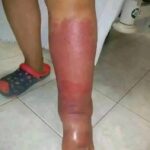 Los Primeros Síntomas de Inflamación y Cómo Aliviarla con Remedios Naturales