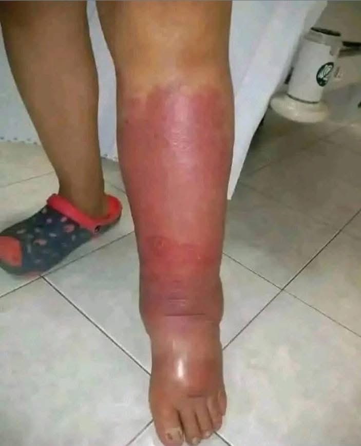 Inflamación en la pierna