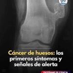 Cáncer de Huesos: Síntomas Iniciales y Señales de Alerta