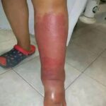 Señales de Inflamación en las Piernas y Remedios Naturales