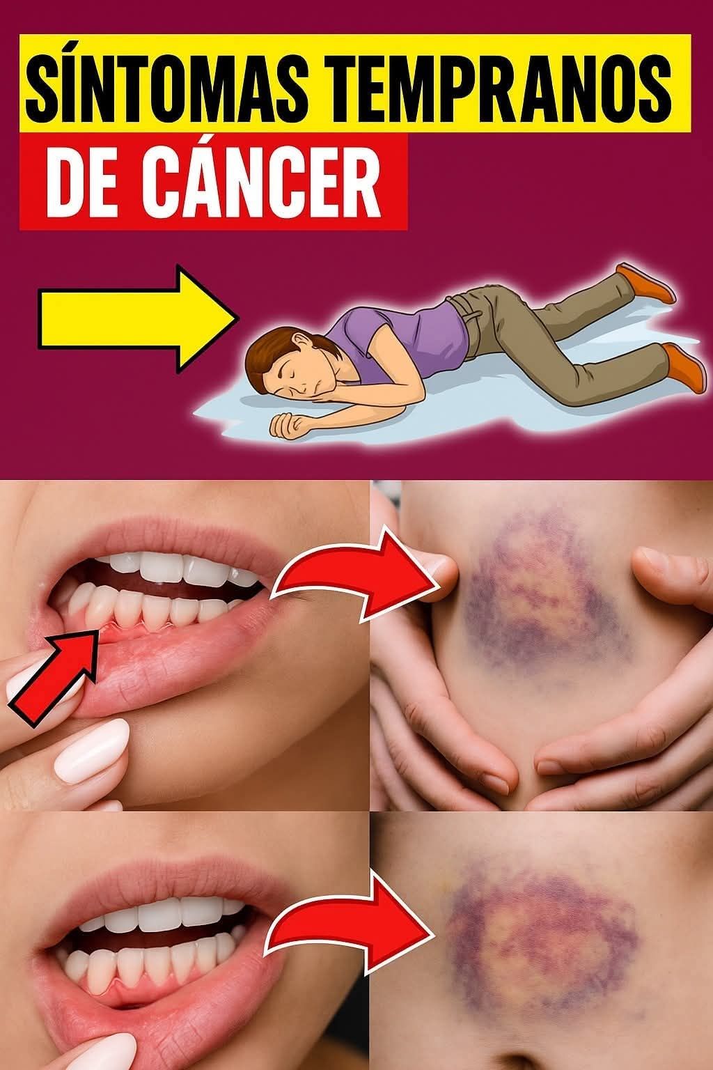 Síntomas tempranos de cáncer