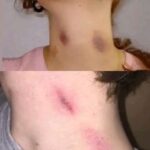 Marcas en la Piel: ¿Chupetones o Ventosas? Entendiendo sus Usos y Beneficios