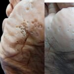 Infección Bacteriana en la Piel: Prevención y Remedios Naturales