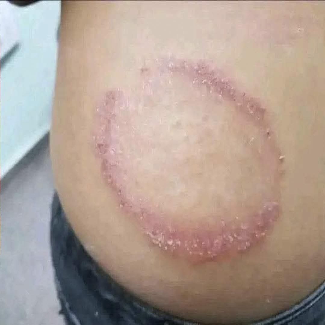 Lesión en la piel por tiña corporal