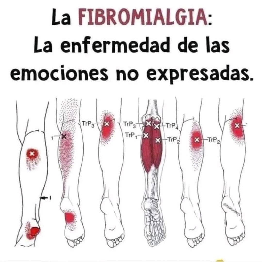 Gráficos de dolor en fibromialgia