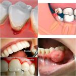 Signos Claro de Problemas Dentales: Reconociendo Gingivitis y Otras Infecciones Bucales