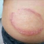Signos de Infecciones Cutáneas: Remedios Naturales y Caseros