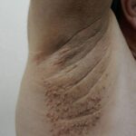 Primeros Síntomas de Afecciones Dermatológicas: Acrocordones y Verrugas