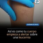 Los Síntomas Alarmantes que Indican Posible Leucemia