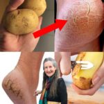 Elimina los Talones Agrietados con este Remedio Natural de Papas