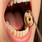 La Importancia de la Salud Dental: Cómo una Carie Puede Afectar Tu Vida