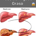 Cómo limpiar tu hígado y cuidar de tu salud