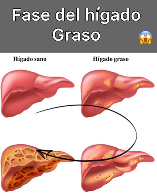 Fases del hígado graso