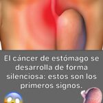 El Secreto Natural que Previene el Cáncer de Estómago