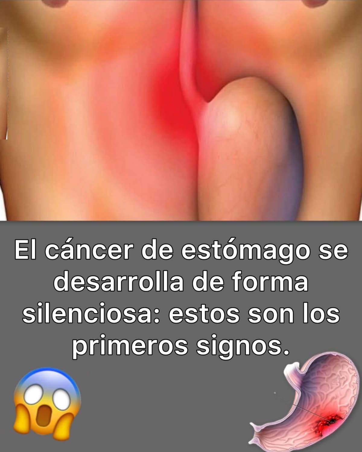 Cáncer de estómago, signos y síntomas