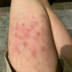 Dale Sentido a tus Moratones: Conoce sus Significados y Remedios Naturales