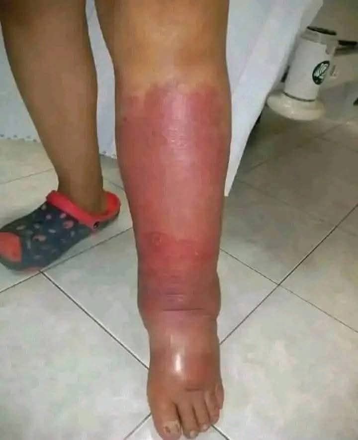 Pierna inflamada