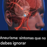 Aneurisma: Señales que No Debes Ignorar