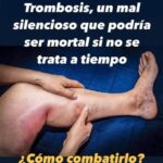 Trombosis: Un Mal Silencioso que Puede Ser Mortal – Conoce los Síntomas y Cómo Combatirlo