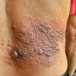 Cómo Tratar Erupciones Cutáneas: Remedios Naturales y Consejos de Salud