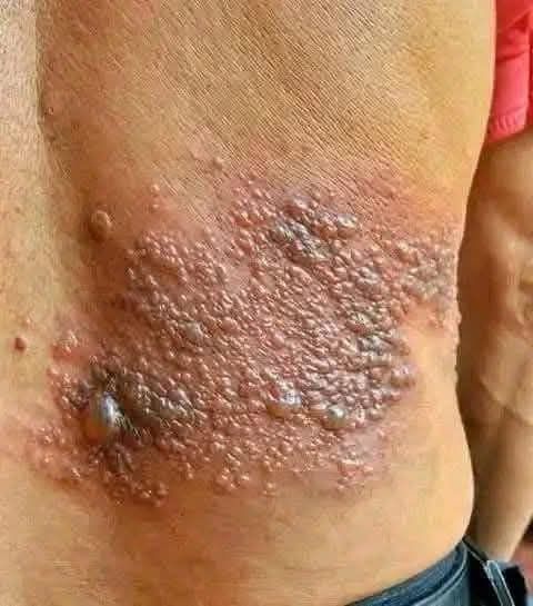 Erupción cutánea con ampollas