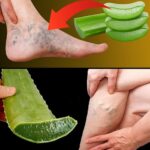 Dile Adiós a las Varices y a la Pesadez de Piernas con Aloe Vera: Un Remedio Natural 100% Efectivo