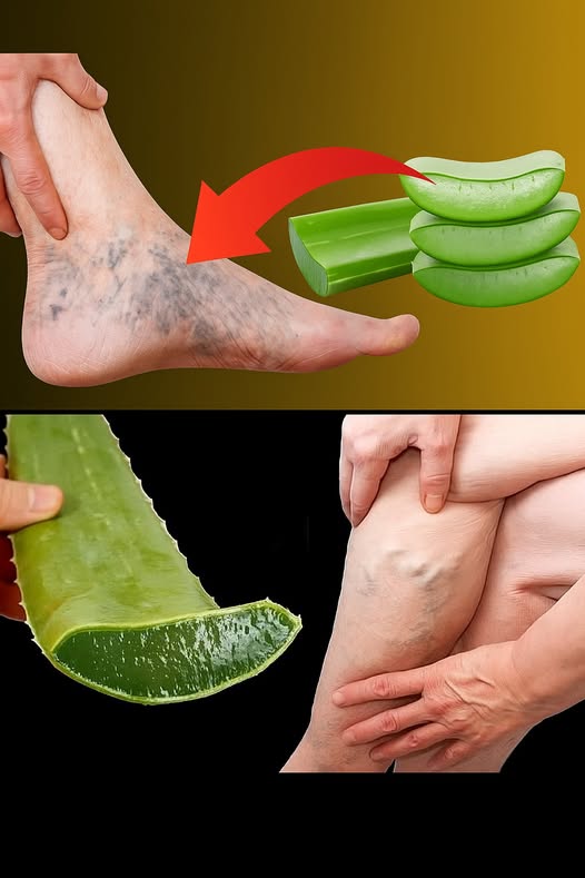 Aloe Vera para tratar varices y pesadez en piernas