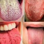 Lengua Blanca y Otros Indicadores de Salud Bucal